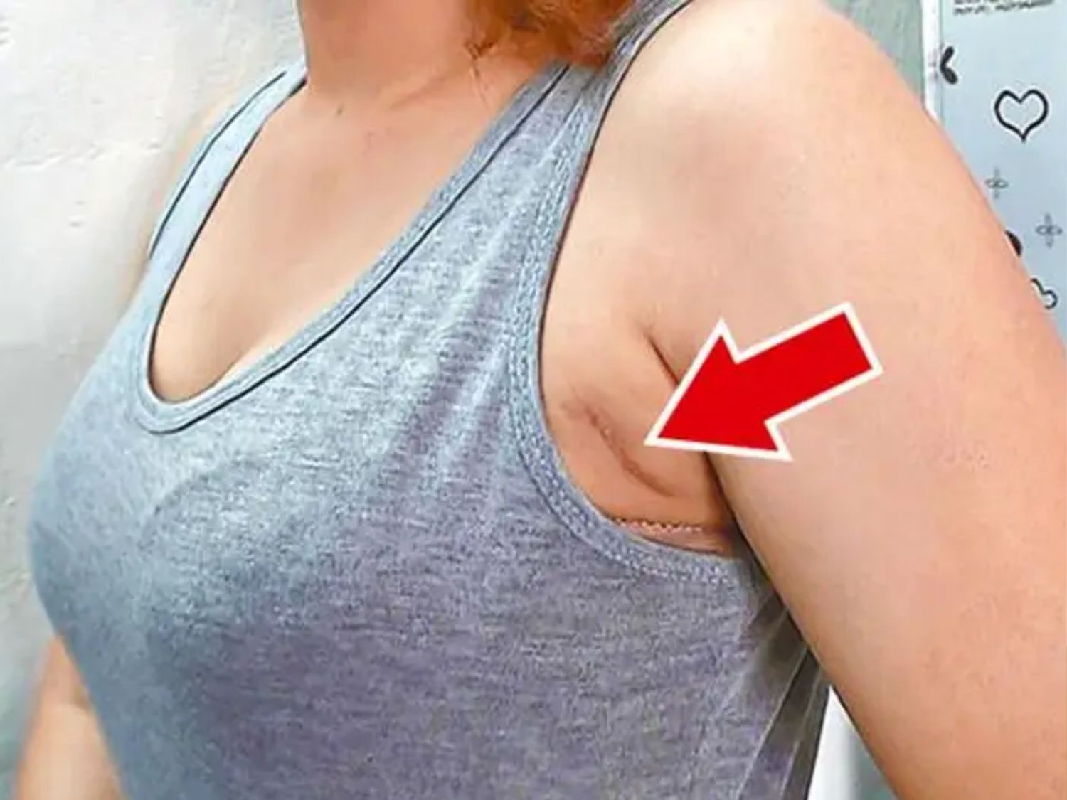 vết sẹo nâng ngực đường nách khó phát hiện