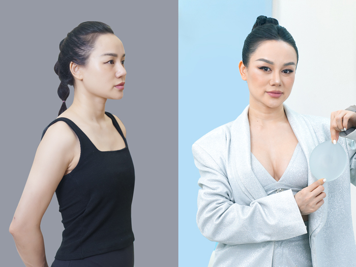 ảnh trước - sau của khách nâng ngực đường nách tại Kangnam