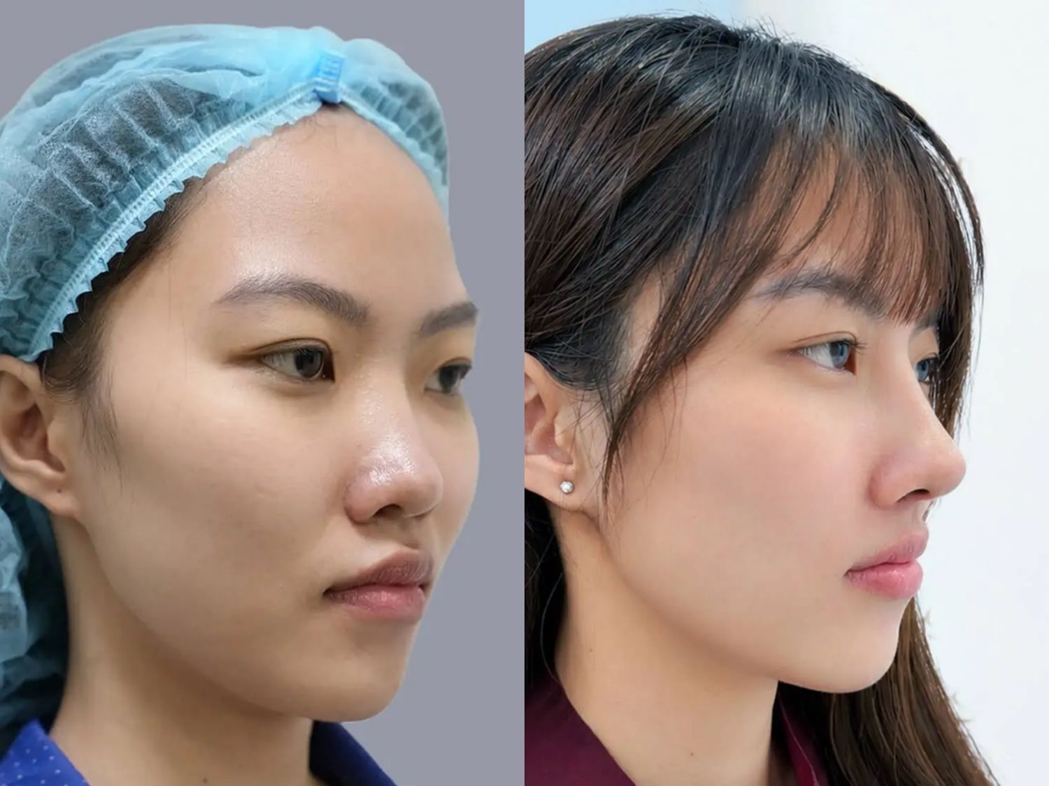 Ngọc Ni có sống mũi thấp, gốc mũi phẳng, đầu mũi ngắn và cánh mũi hơi bè. Sau nâng mũi sở hữu dáng mũi cao tự nhiên , hợp với nét mặt Á Đông