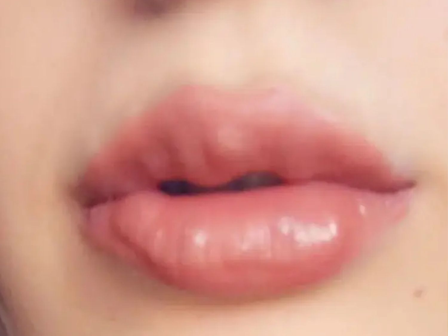 Môi bị vón cục lồi lõm sau khi tiêm filler