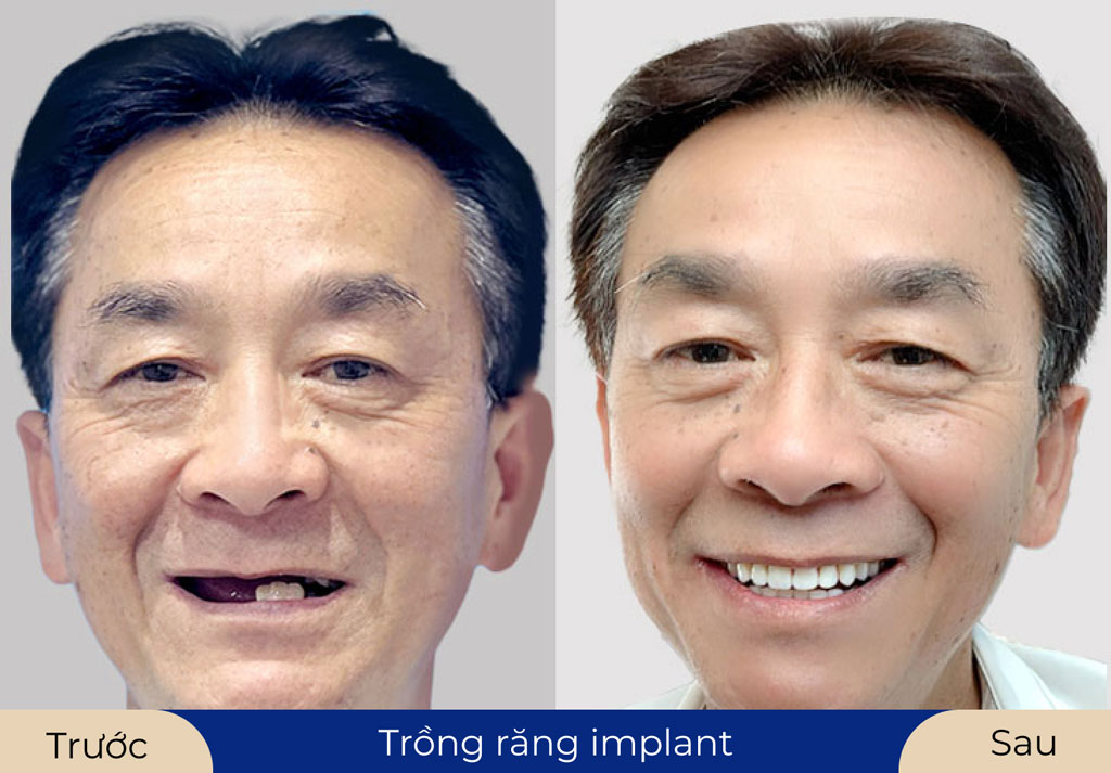 Khách sau khi cắm Implant phục hình răng, tự tin với nụ cười mới