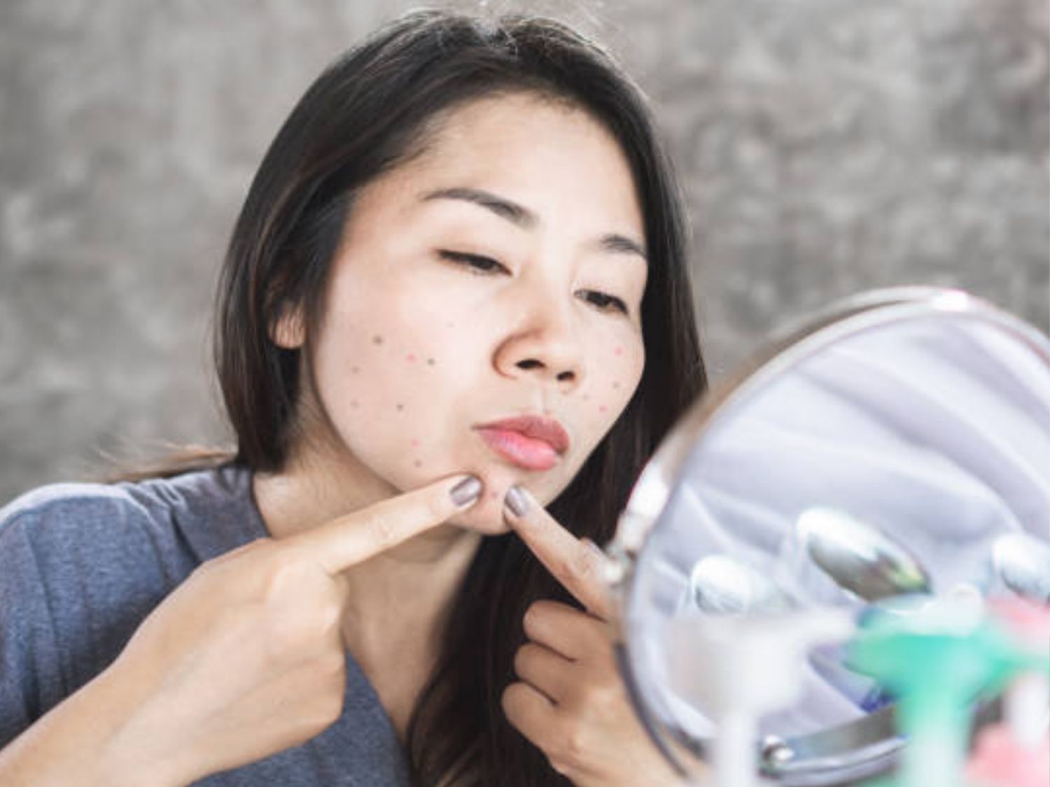 Quá trình nặn mụn không sạch là nguyên nhân khiến da bị nhiễm trùng sau nặn mụn