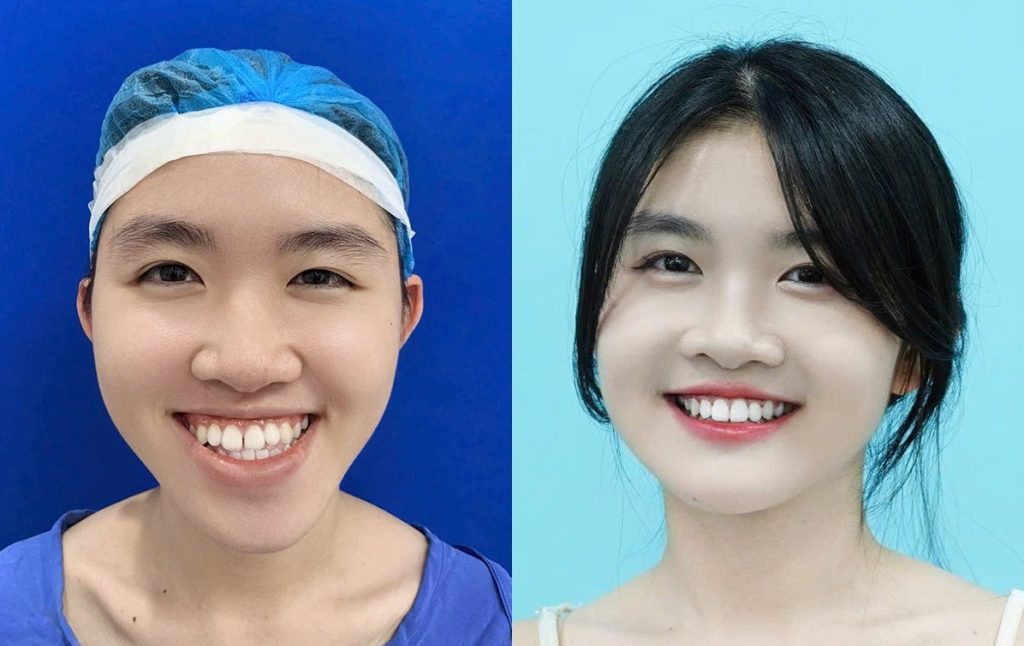 chỉnh hàm lệch, sai khớp cắn tại Kangnam, khách hàng sở hữu gương mặt cân đối