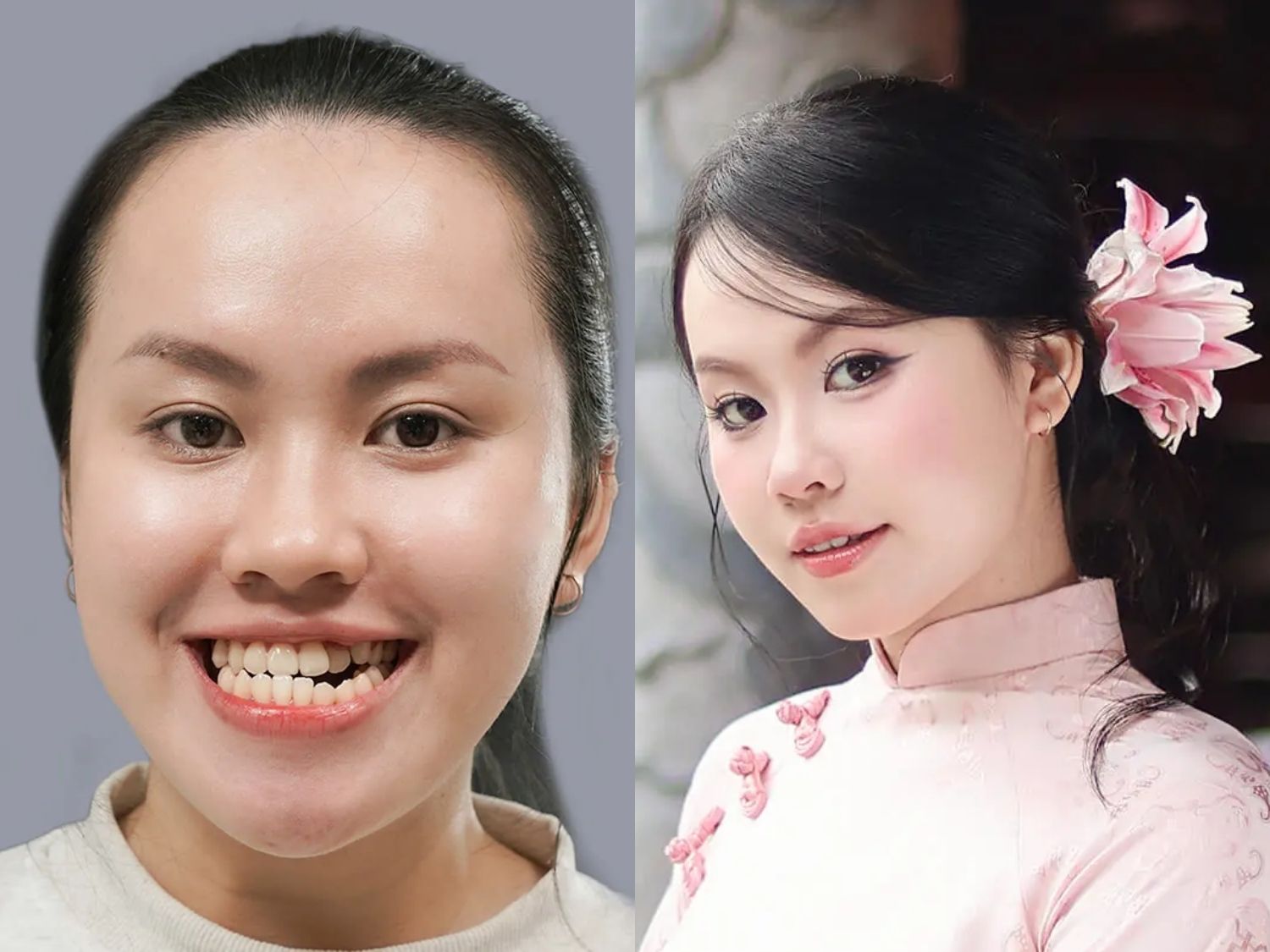 Phương Quyên gặp tình trạng khớp cắn ngược, cằm dài và trục hàm lệch. Sau phẫu thuật gương mặt cân đối