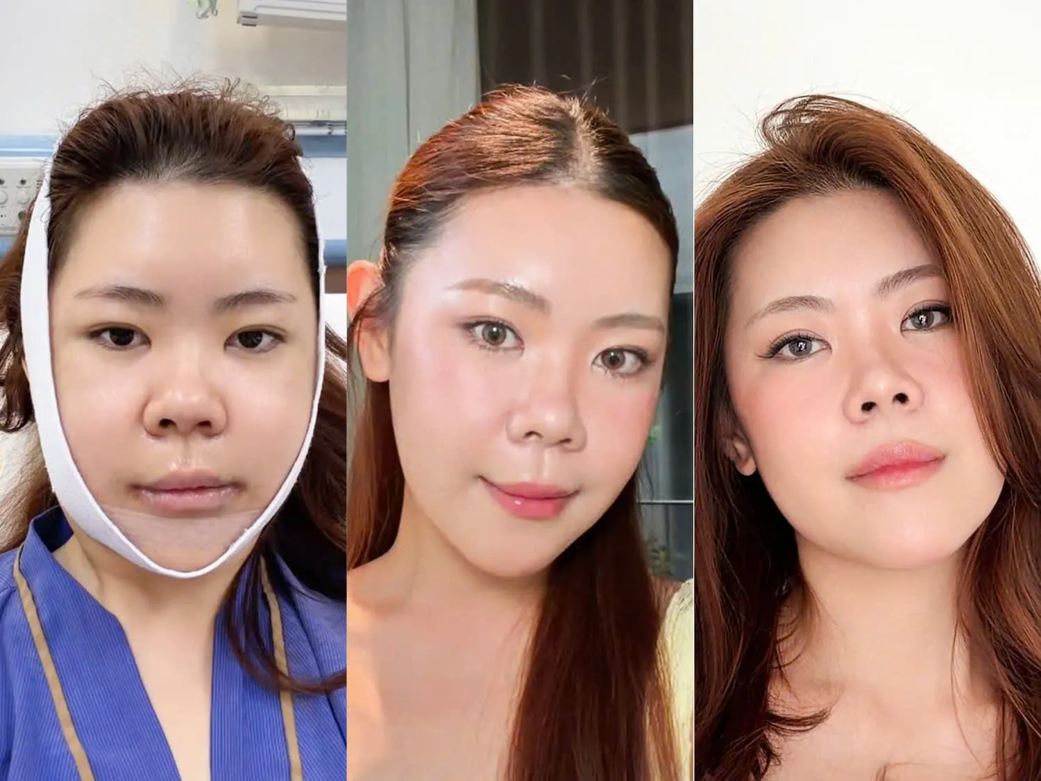 TikToker “Đông có Anh” và quá trình biến đổi sau chỉnh hàm