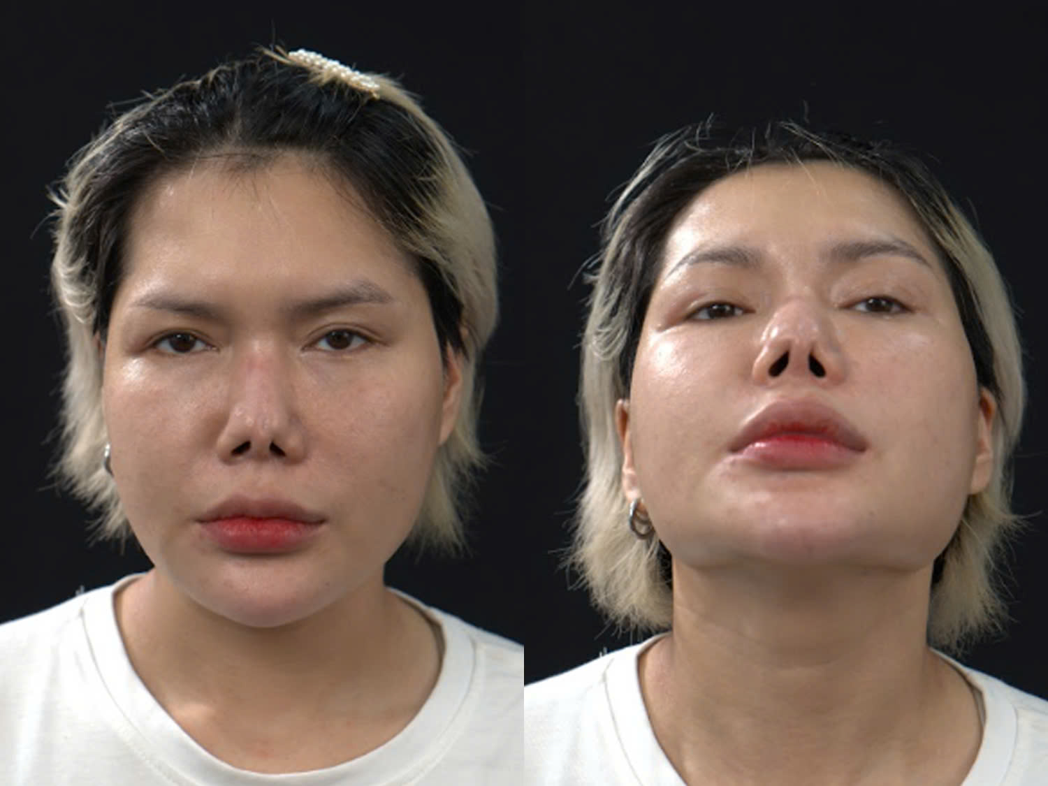 Mũi co rút, biến chứng khi thực hiện tại các cơ sở giá rẻ, không đảm bảo yếu tố bác sĩ, chất lượng sụn