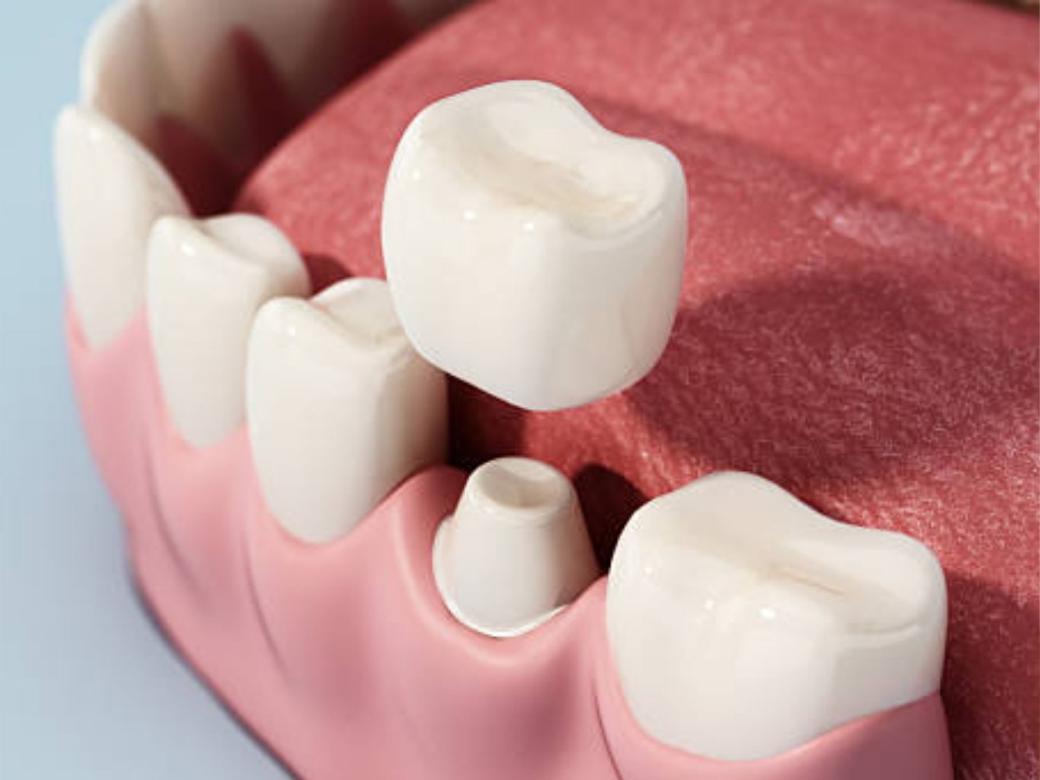 Phục hình lại khi răng và nướu ổn định để tăng tính thẩm mỹ và quá trình ăn uống