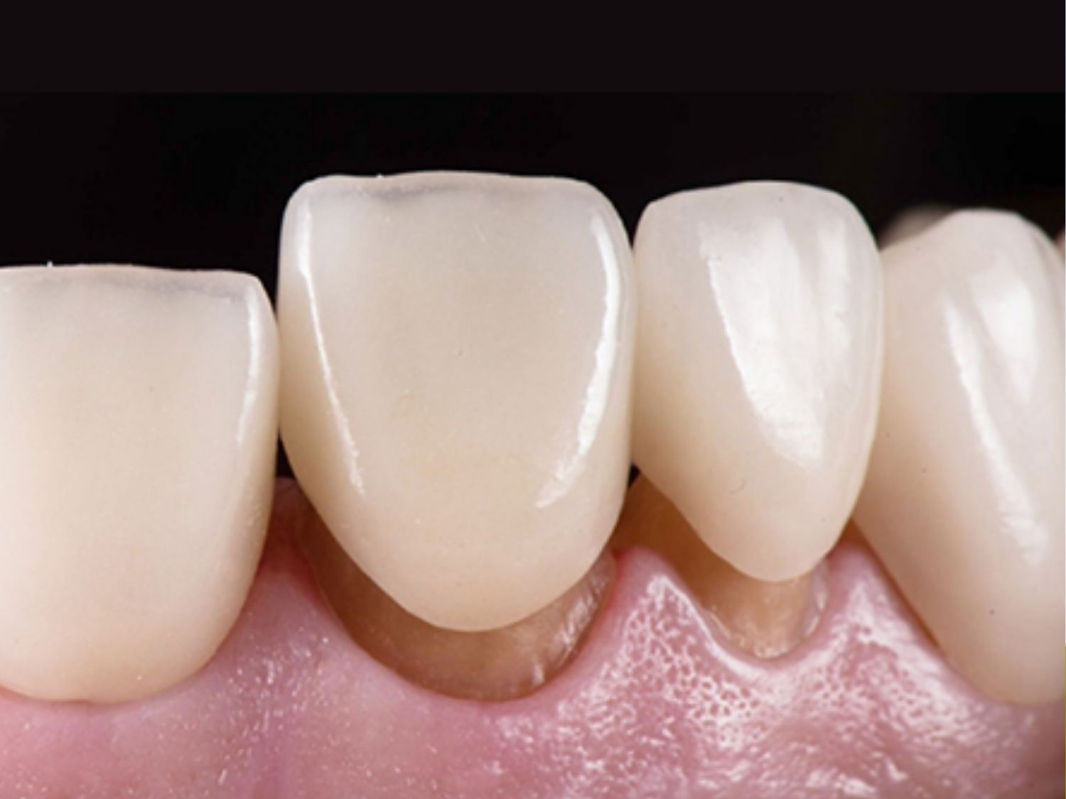 tình trạng hở cổ răng cần thay thế mão sứ mới