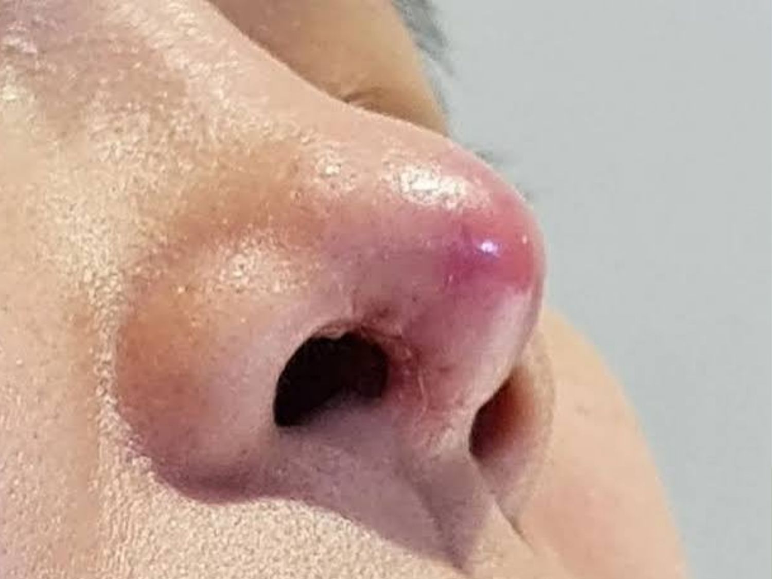 đầu mũi bóng đỏ, mũi sưng và có cảm giác hơi đau nhẹ