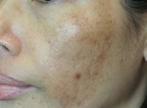 Tăng sắc tố sau laser có thể biểu hiện bằng các đốm hoặc mảng da sẫm màu tại vùng đã điều trị, liên quan đến phản ứng viêm, đặc điểm nền da và quá trình chăm sóc sau laser.