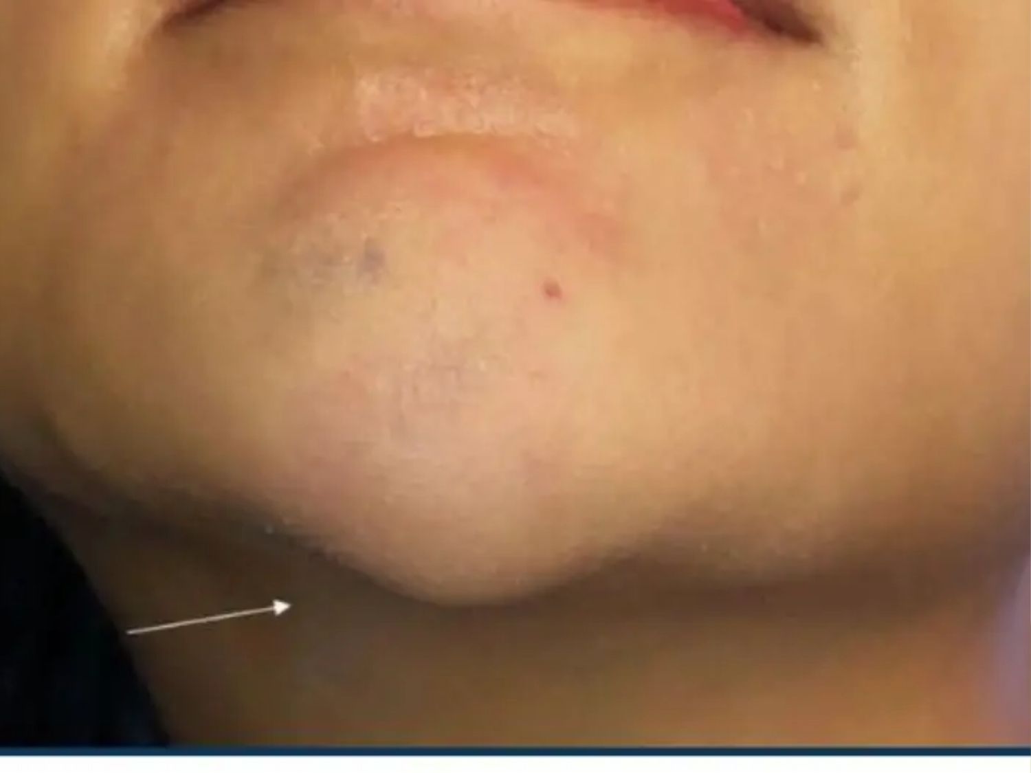 Vùng cằm sưng và nhức sau tiêm filler