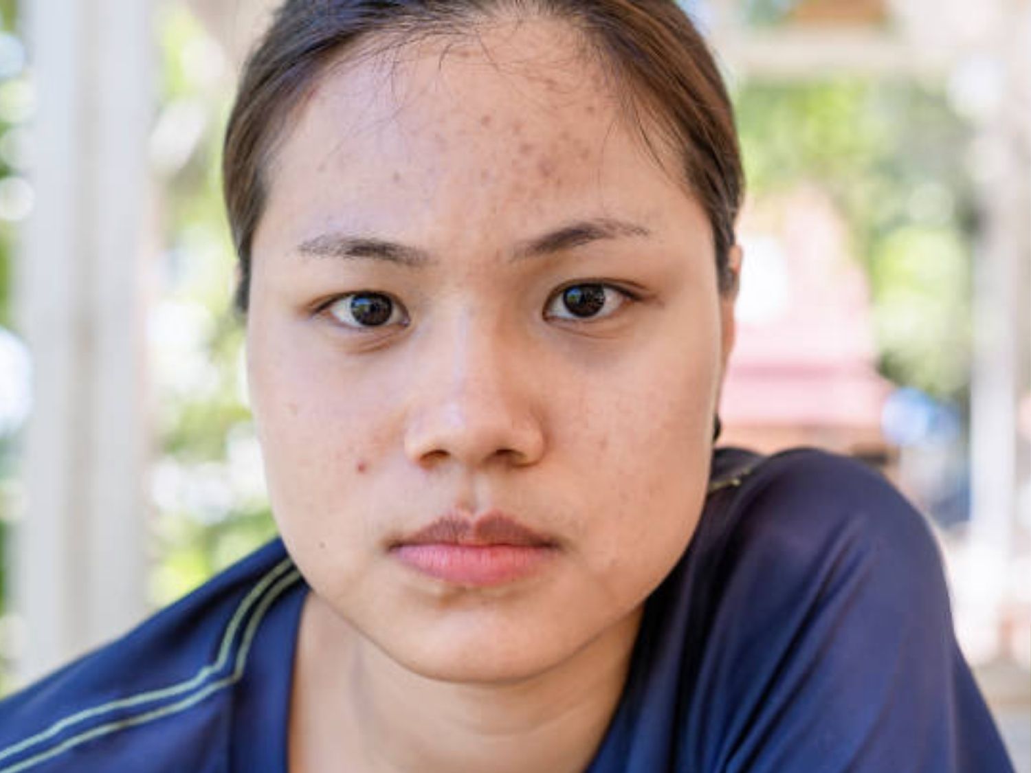 Sờ vào vùng tiêm như má sưng và vón cục