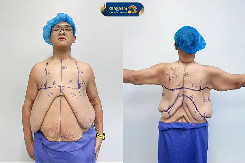 Tình trạng da thừa, chùng nhão của khách hàng cần loại bỏ