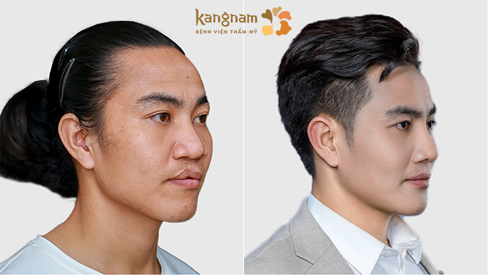 Khách hàng nâng mũi L line tại kangnam sở hữu gương mặt nam tính hơn
