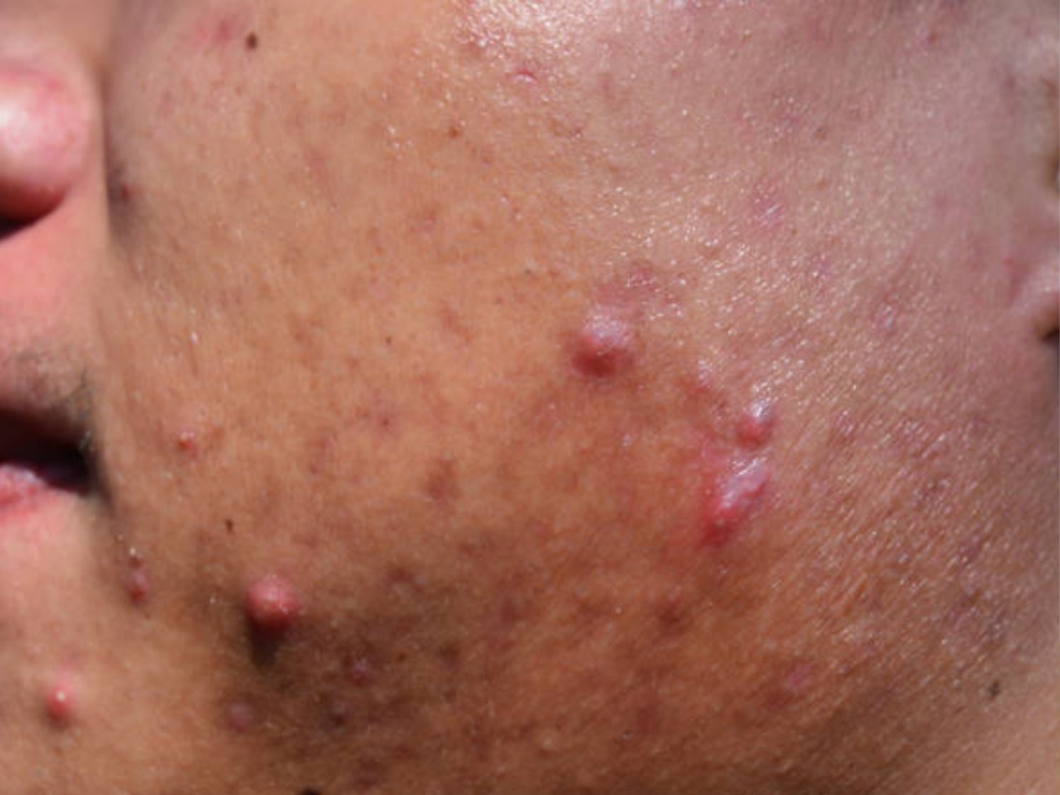 Mụn bọc do tế bào da chết và vi khuẩn P. acnes (hiện nay còn gọi là C. acnes) tích tụ sâu trong lỗ chân lông gây viêm nhiễm diện rộng