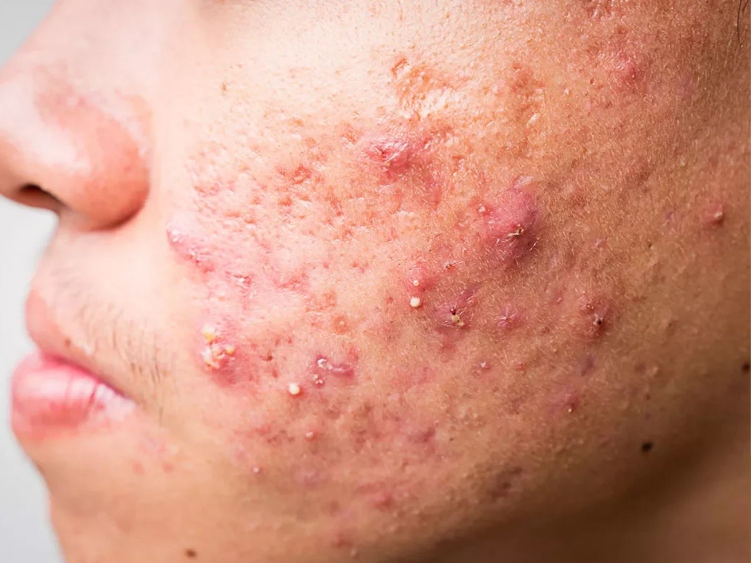 Mụn viêm hình thành tăng sinh mạnh mẽ và lan sang toàn bộ da mặt