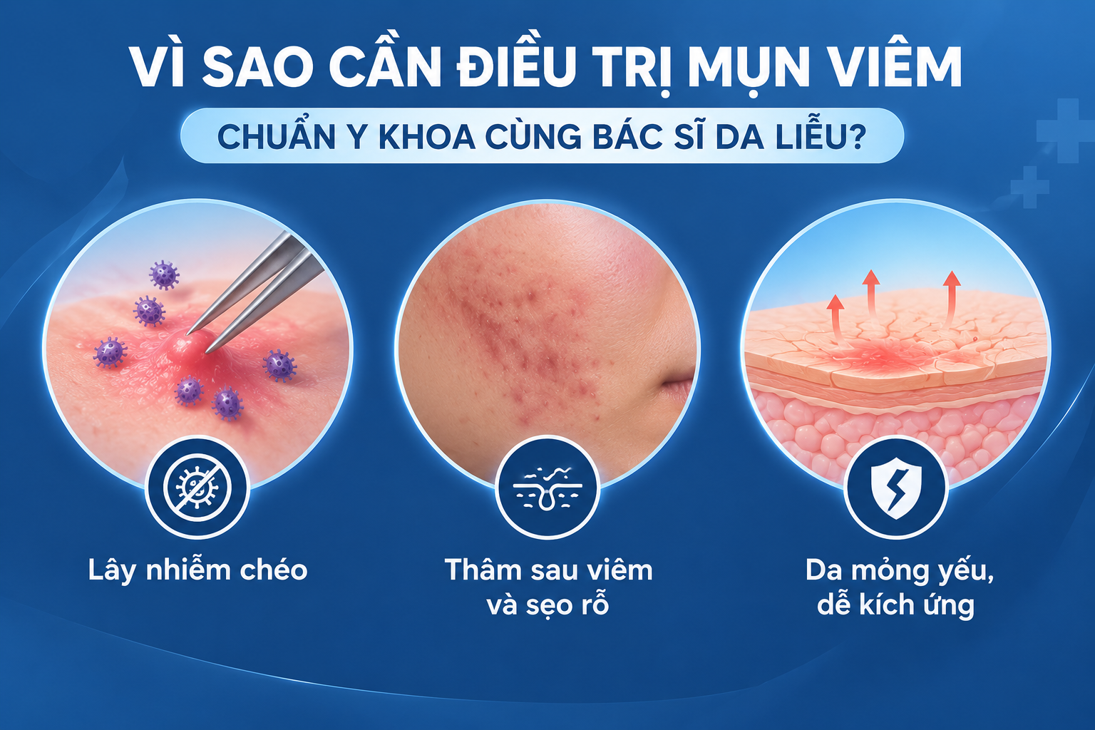 Lý do cần điều trị mụn viêm cùng bác sĩ da liễu