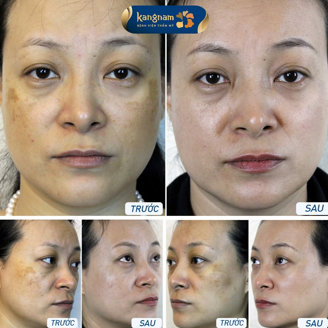 Sự thay đổi của vùng nám sau điều trị, với sắc tố trên má giảm và nền da trông đều màu hơn tại Kangnam