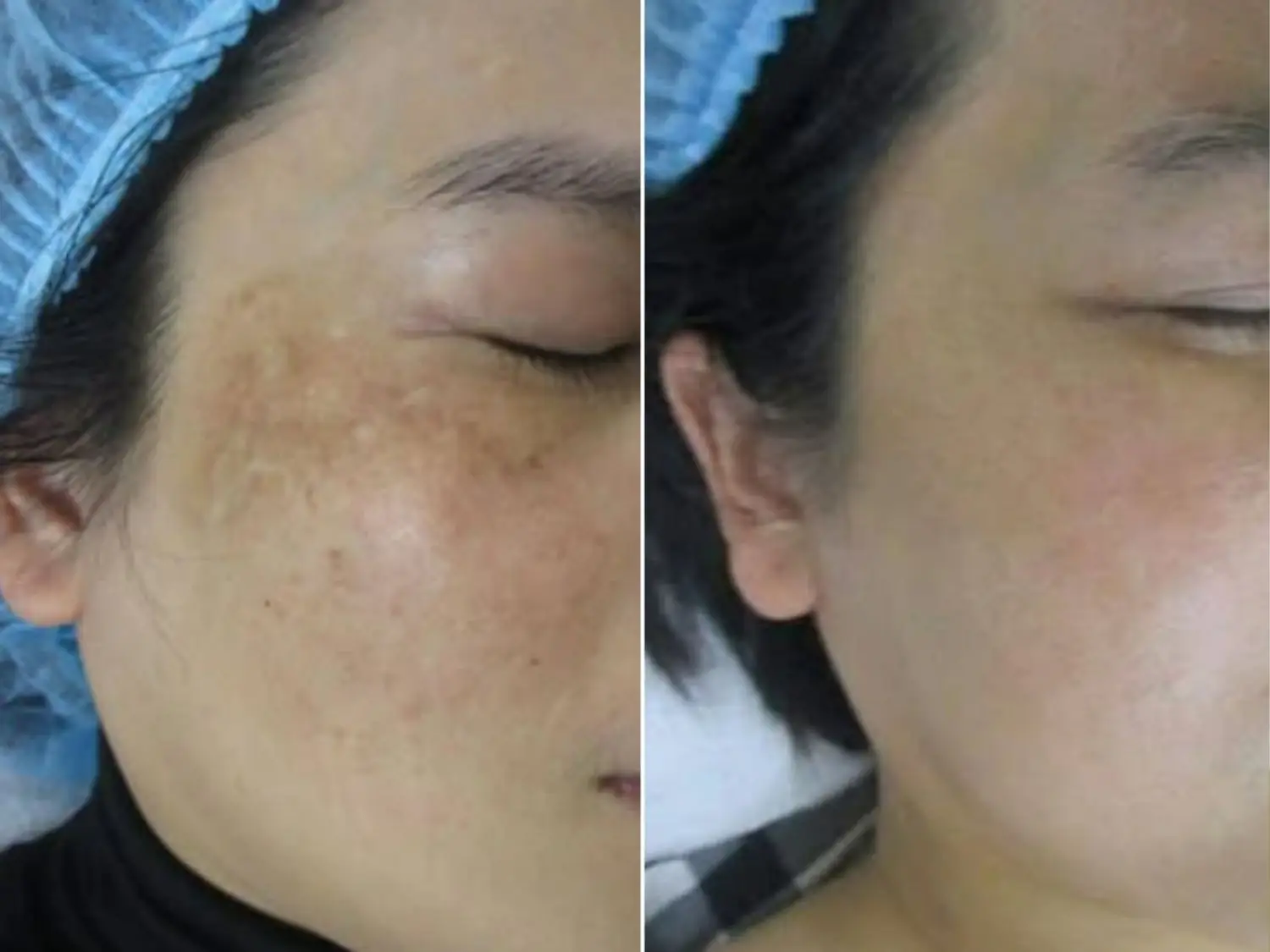 Sau điều trị, các vùng sắc tố trên má có thể mờ dần và nền da trở nên đồng đều hơn, tùy loại nám và đáp ứng của từng khách hàng.