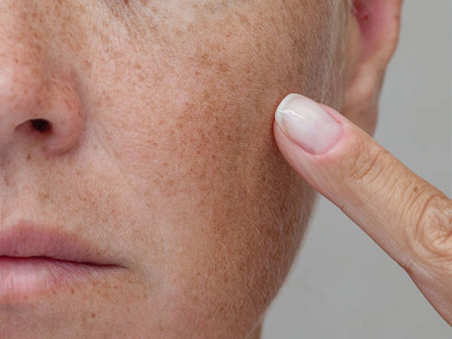 Nám lâu năm là kết quả của quá trình rối loạn sản sinh Melanin kéo dài ở cấp độ tế bào
