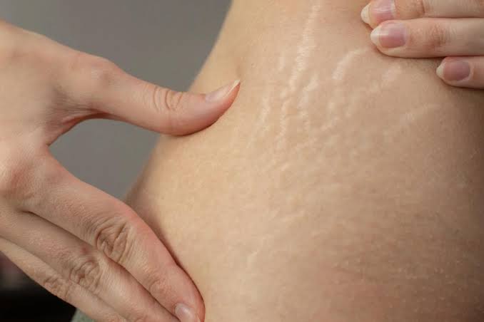 Độ rạn da không thuyên giảm sau nhiều buổi điều trị