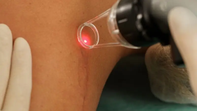 Laser là một trong những phương pháp được sử dụng để cải thiện sẹo, với thông số điều trị cần được lựa chọn dựa trên loại sẹo, độ dày, màu sắc và tình trạng da.
