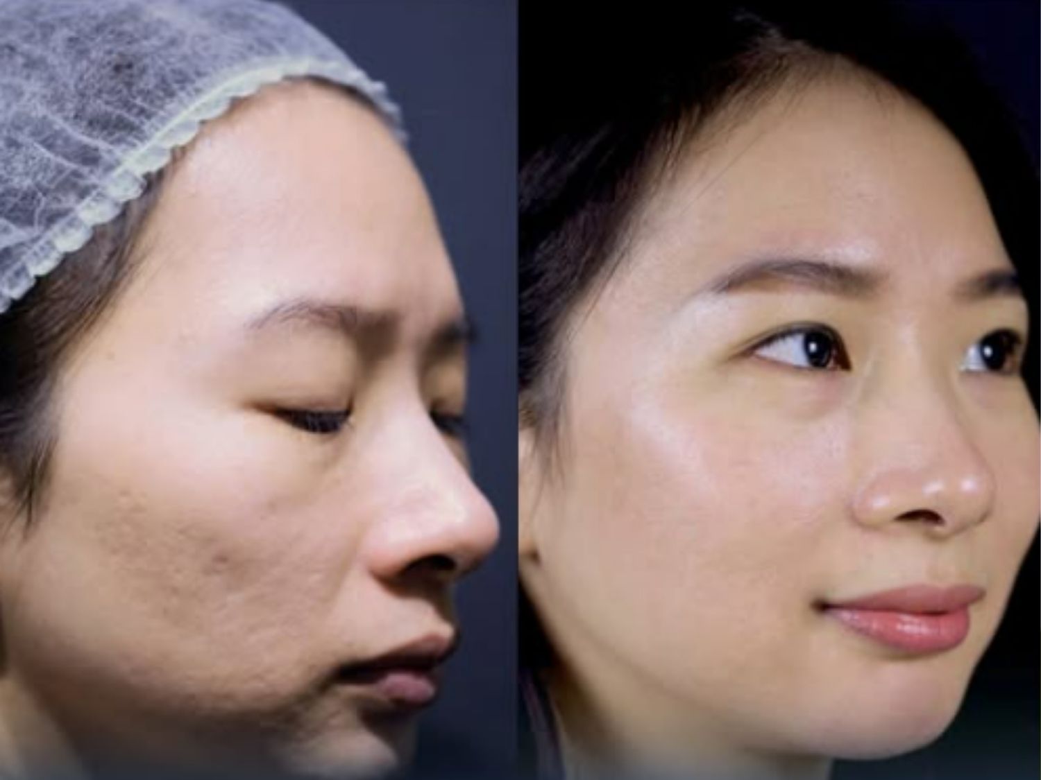 khách hàng trước và sau khi trị sẹo rỗ tại Cần Thơ. Da láng mịn, sáng khỏe hơn sau liệu trình