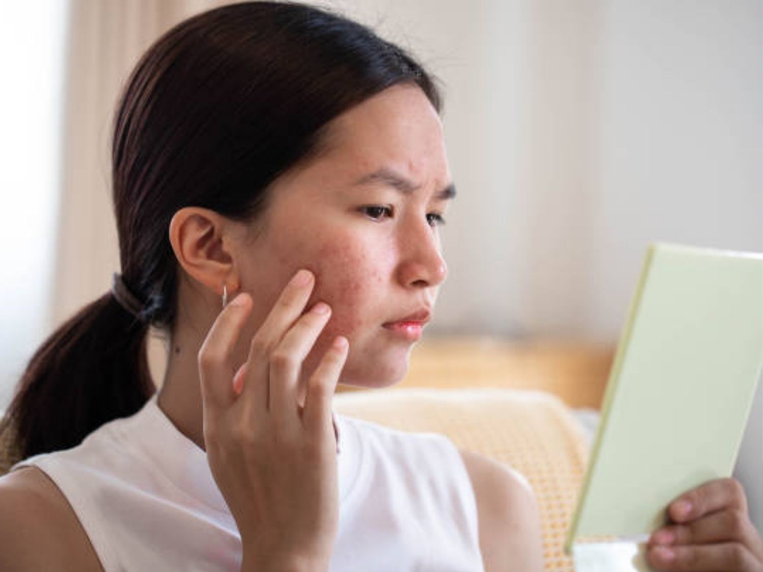 Sẹo rỗ, sẹo mụn sau khi mụn viêm tiến triển nặng
