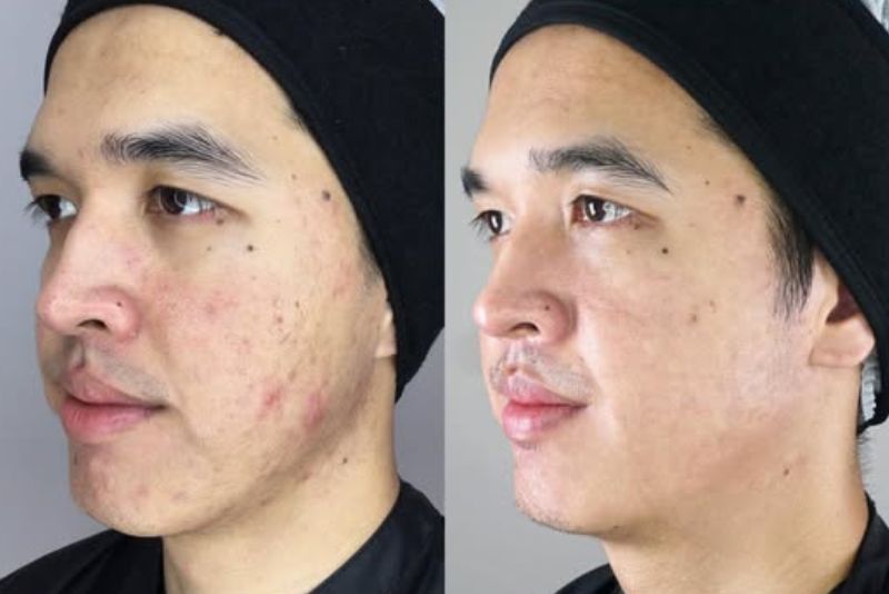 khách hàng có mụn viêm sưng đỏ, thâm sẹo nhiều. Sau điều trị sở hữu làn da mịn màng, sạch thâm