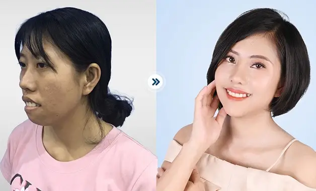Phẫu thuật hàm hô thay đổi ngoại hình ngoạn mục 