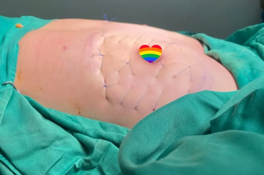 Phẫu thuật thu nhỏ ngực phụ thuộc vào nhiều yếu tố