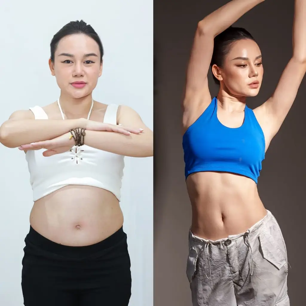 Vòng eo săn chắc, thọn gọn sau khi hút mỡ 