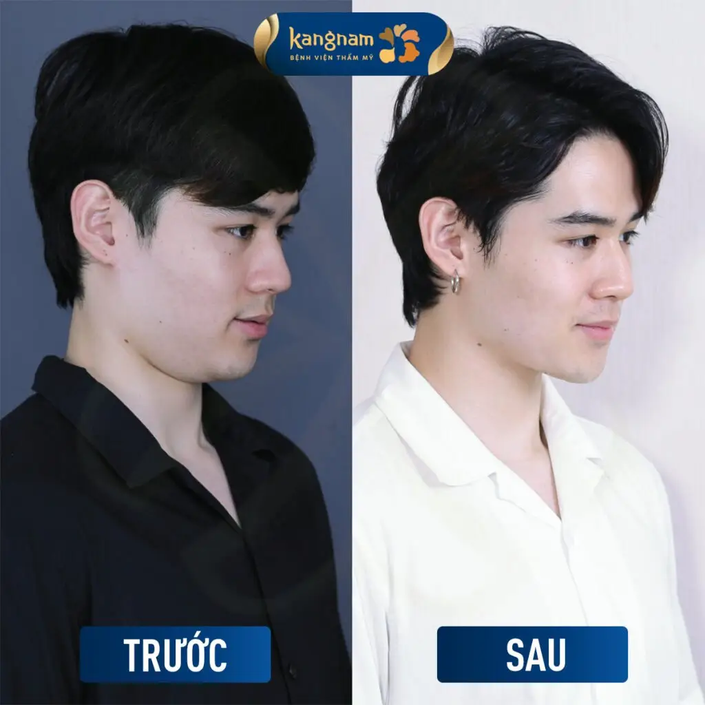 Khuôn mặt thọn gọn khi hút mỡ nọng cằm khoảng 5 ngày