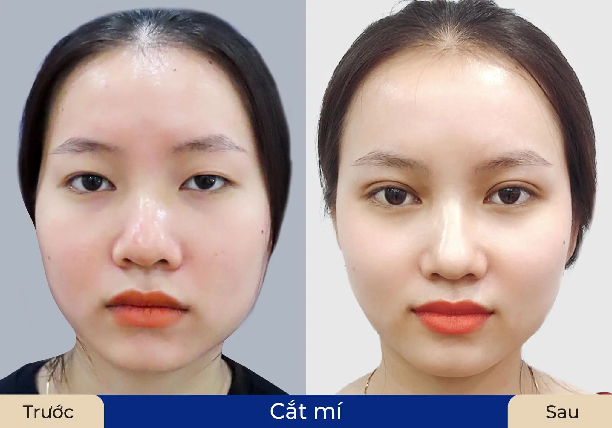 Sau khi ổn định, nếp mí đẹp tự nhiên, gương mặt hài hòa