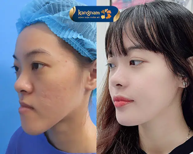 Chỉnh sửa mặt lưỡi cày giúp gương mặt thanh thoát, cân đối hơn