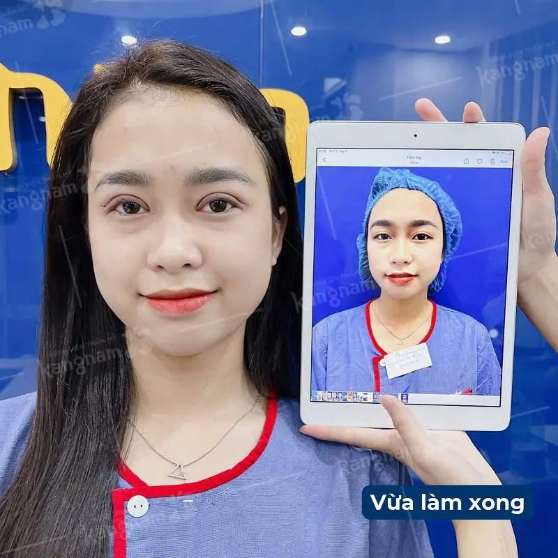 Mí mắt bị sưng tấy sau khi vừa cắt mí