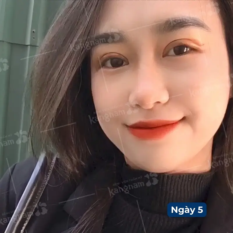 Sau 5 ngày cắt mí tình trạng sưng nề đã giảm rõ rệt