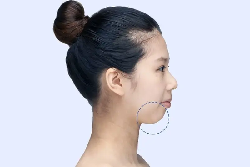 Cằm lẹm là