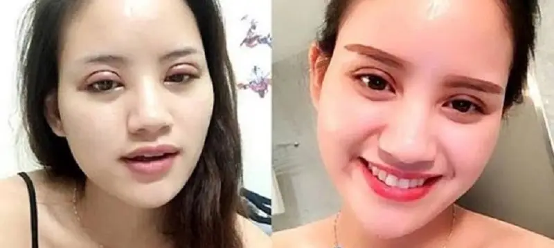 Trường hợp mí mắt sưng tấy dữ dội, kéo dài