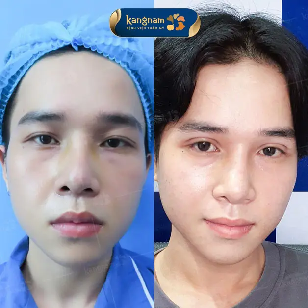 Nhấn mí không cần nghỉ dưỡng lâu, tạo nếp mí tự nhiên