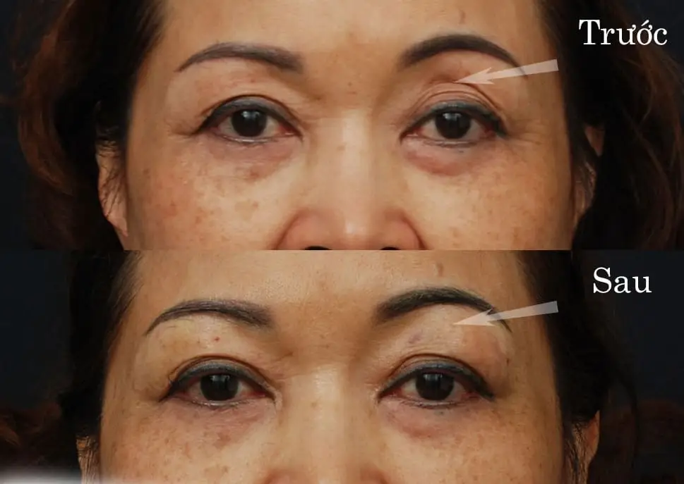 Đôi mắt tươi trẻ hơn sau khi cấy mỡ hốc mắt