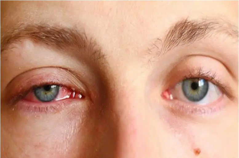 Tình trạng sưng sau khi cấy mỡ hốc mắt giảm dần sau 2 tuần cấy mỡ 