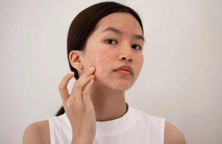 Không chạm tay vào vùng mới trị nám