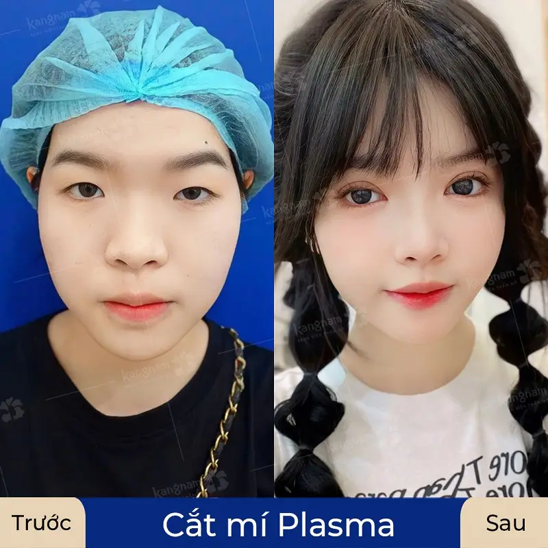Cắt mí Plasma giúp khách hàng sở hữu đôi mắt to tròn, cân đối lâu dài