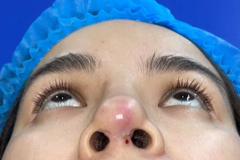 Mũi tím tái trong thời gian dài