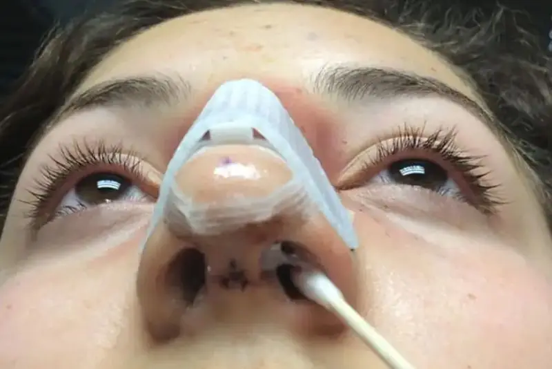 Tụ dịch là hiện tượng thường gặp sau phẫu thuật