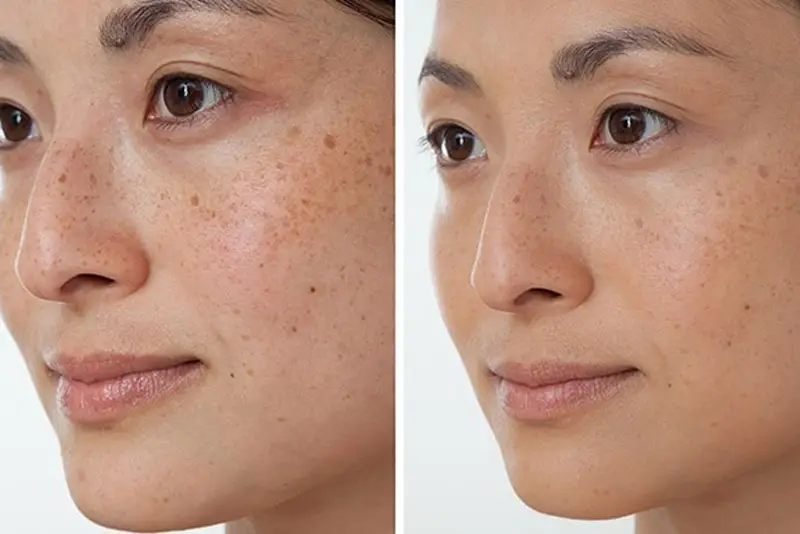 Điều trị tàn nhang