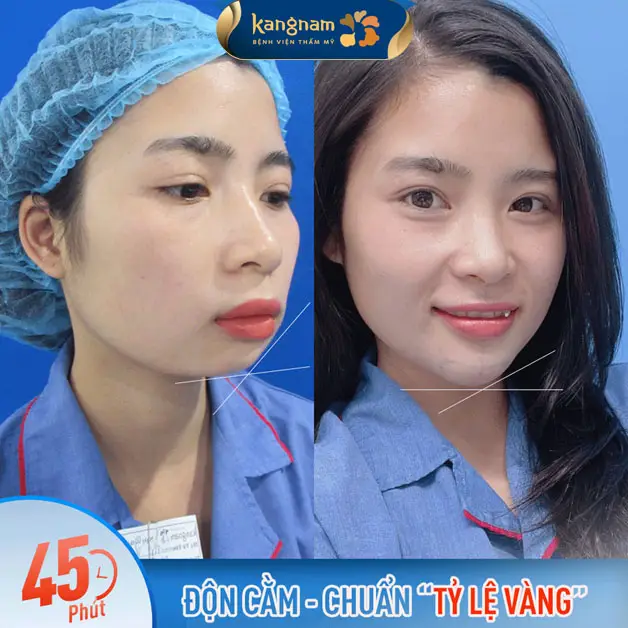 Độn cằm tạo cằm V-line, cải thiện cằm vuông thô