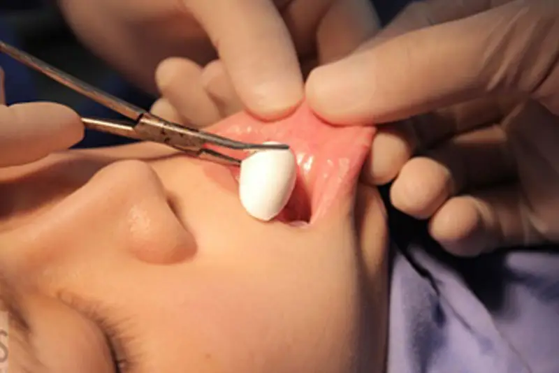 Miếng độn cằm đưa vào từ trong khoang miệng