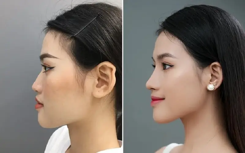 Sau khi độn cằm khuôn mặt của khách hàng cân đối, thăng hạng nhan sắc hơn